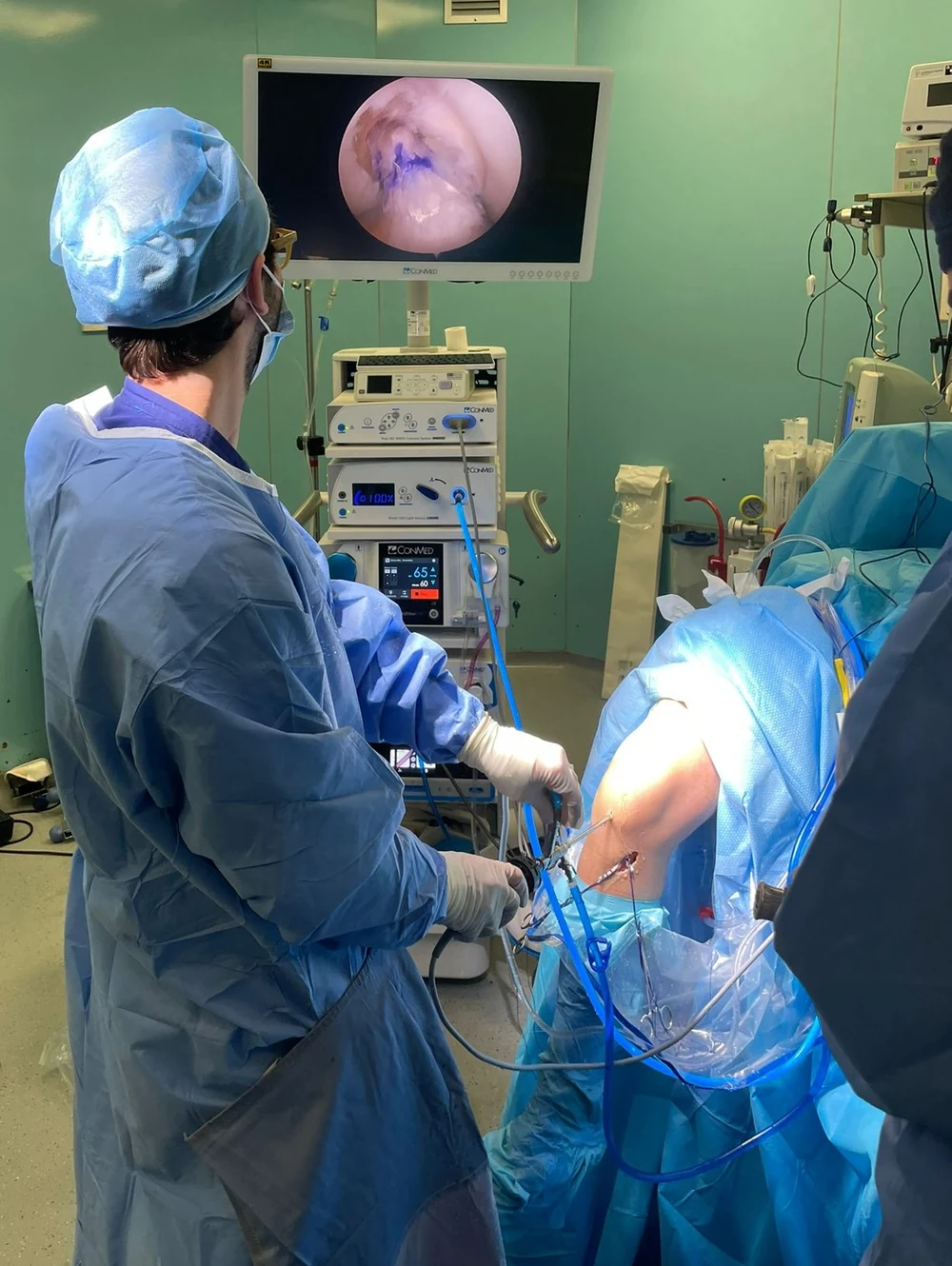 Il Dr. Saccone durante un'artroscopia di spalla, con l'immagine artroscopica sul monitor
